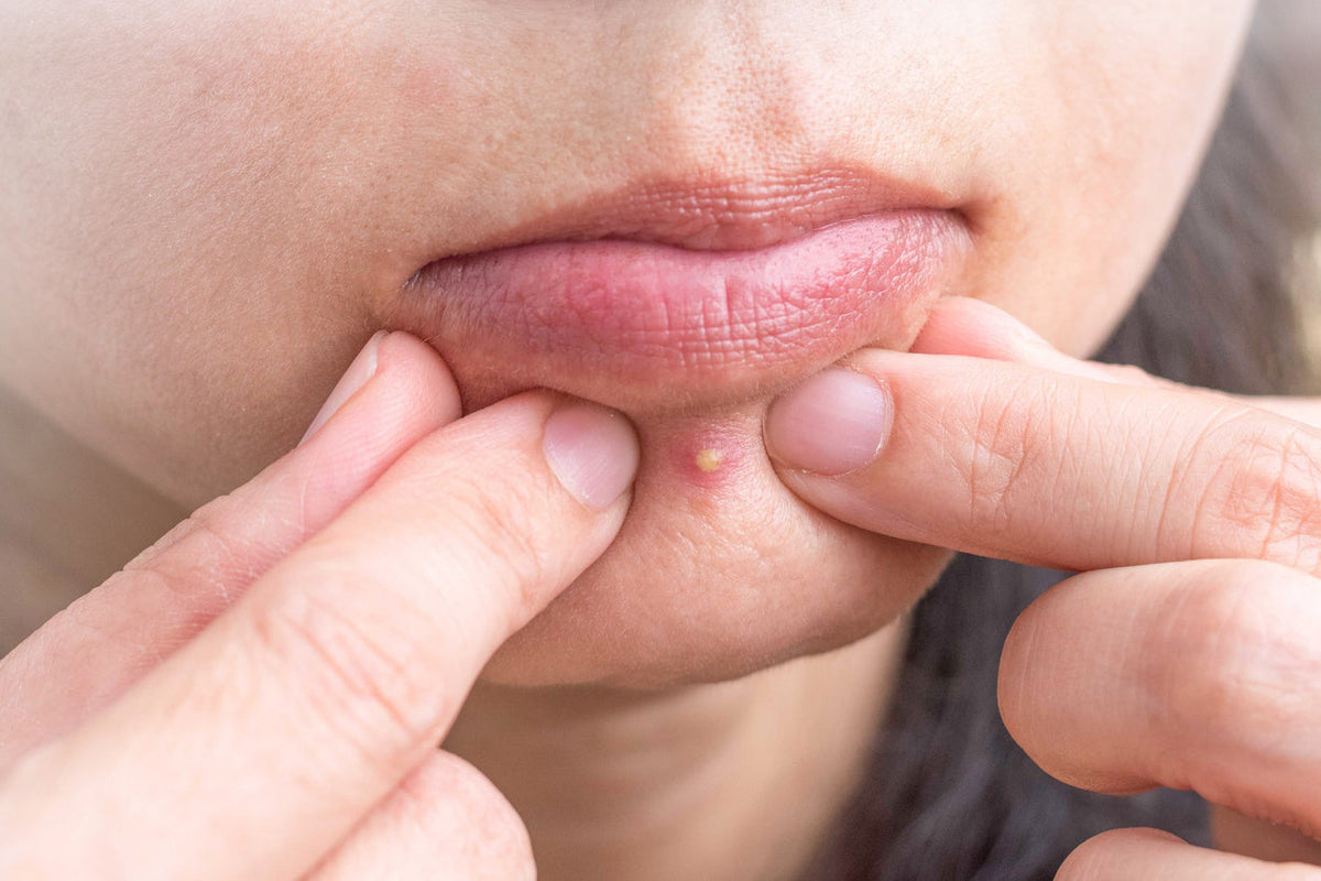 Acne vs. pimples: What’s the difference?